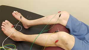 Acupuncture Treatments near Minneapolis